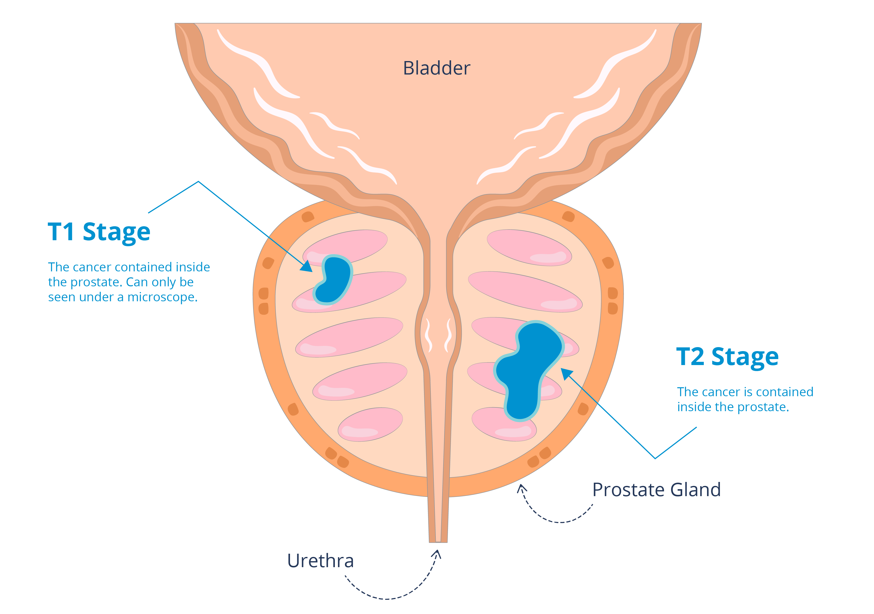 Image showing T1 and T2 tumours in the prostate