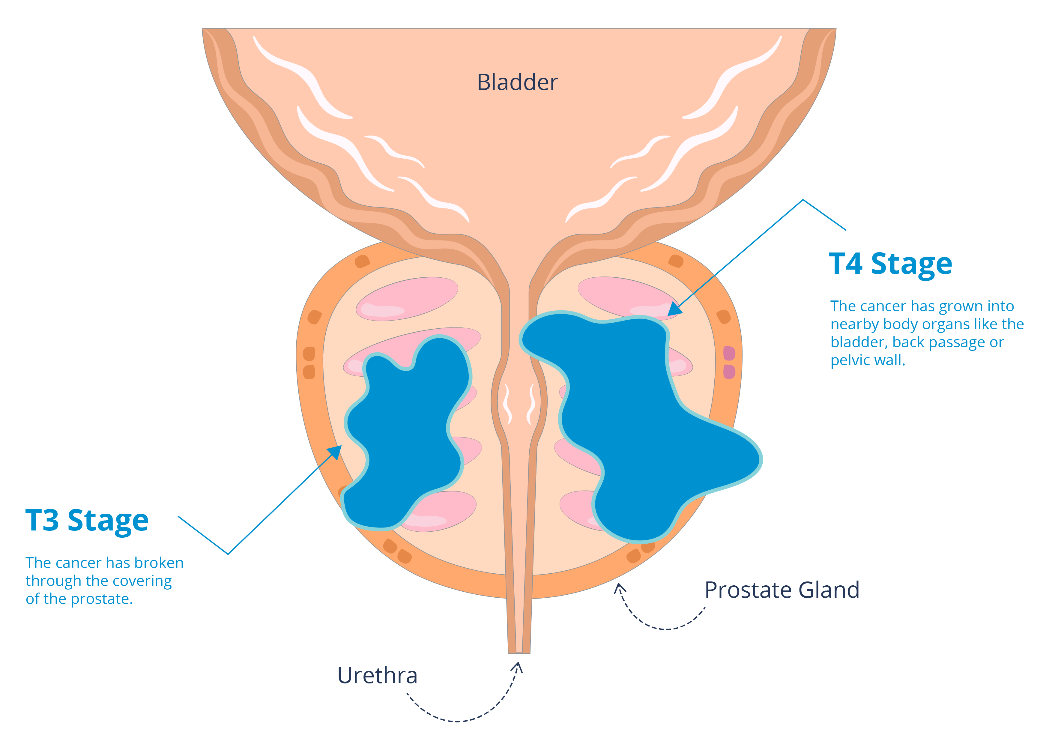 Image showing T3 and T4 tumours within the prostate