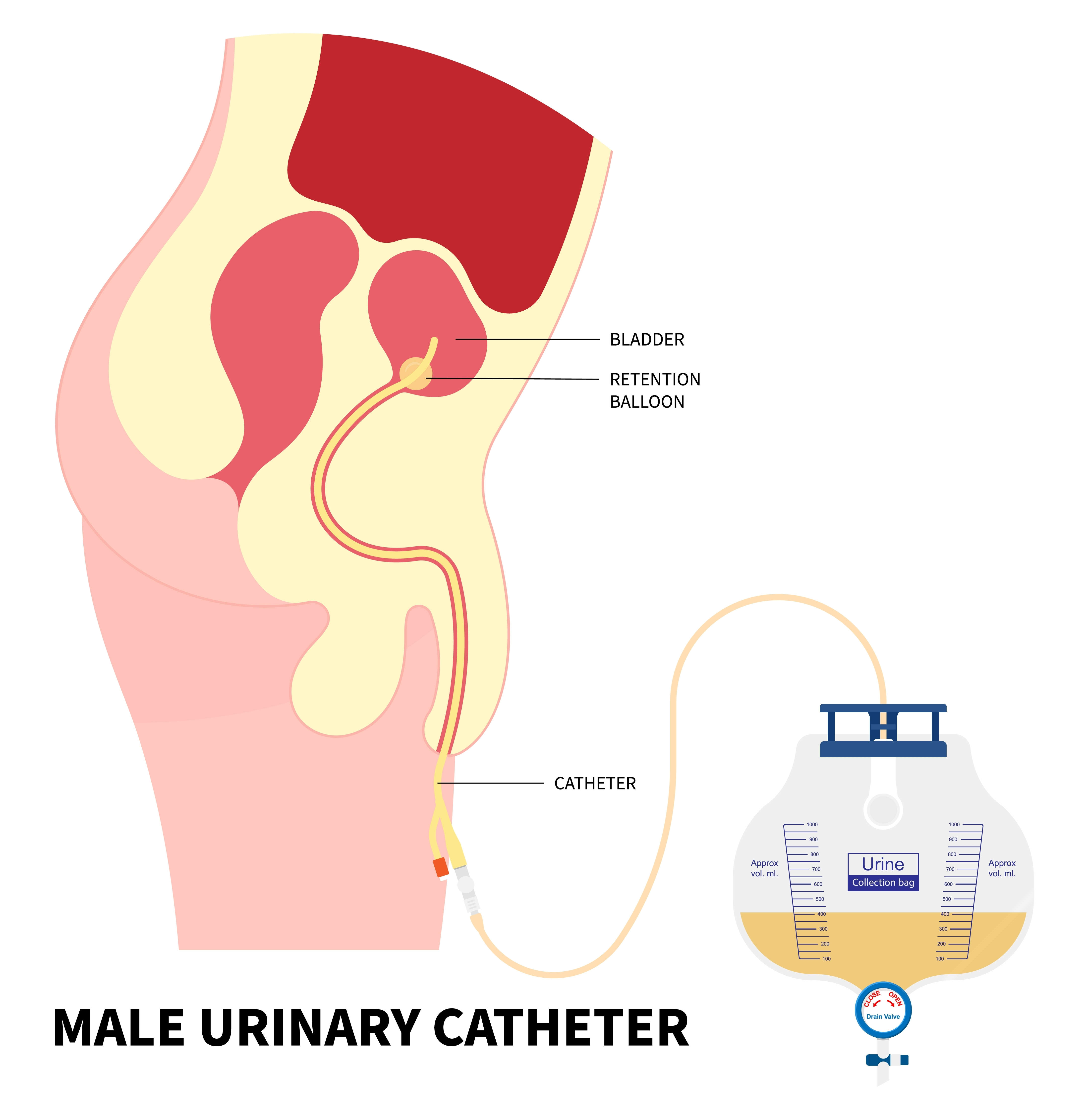 Male urinary catheter