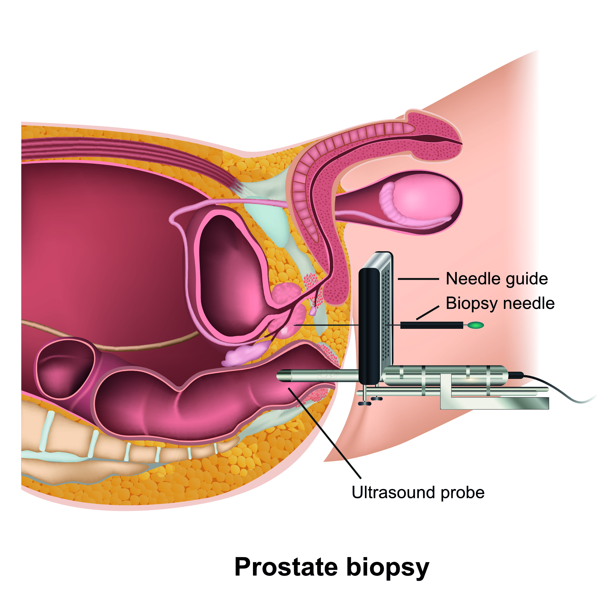 perineal prostate biospy illustration