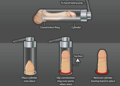 Illustration of penile vacuum pump