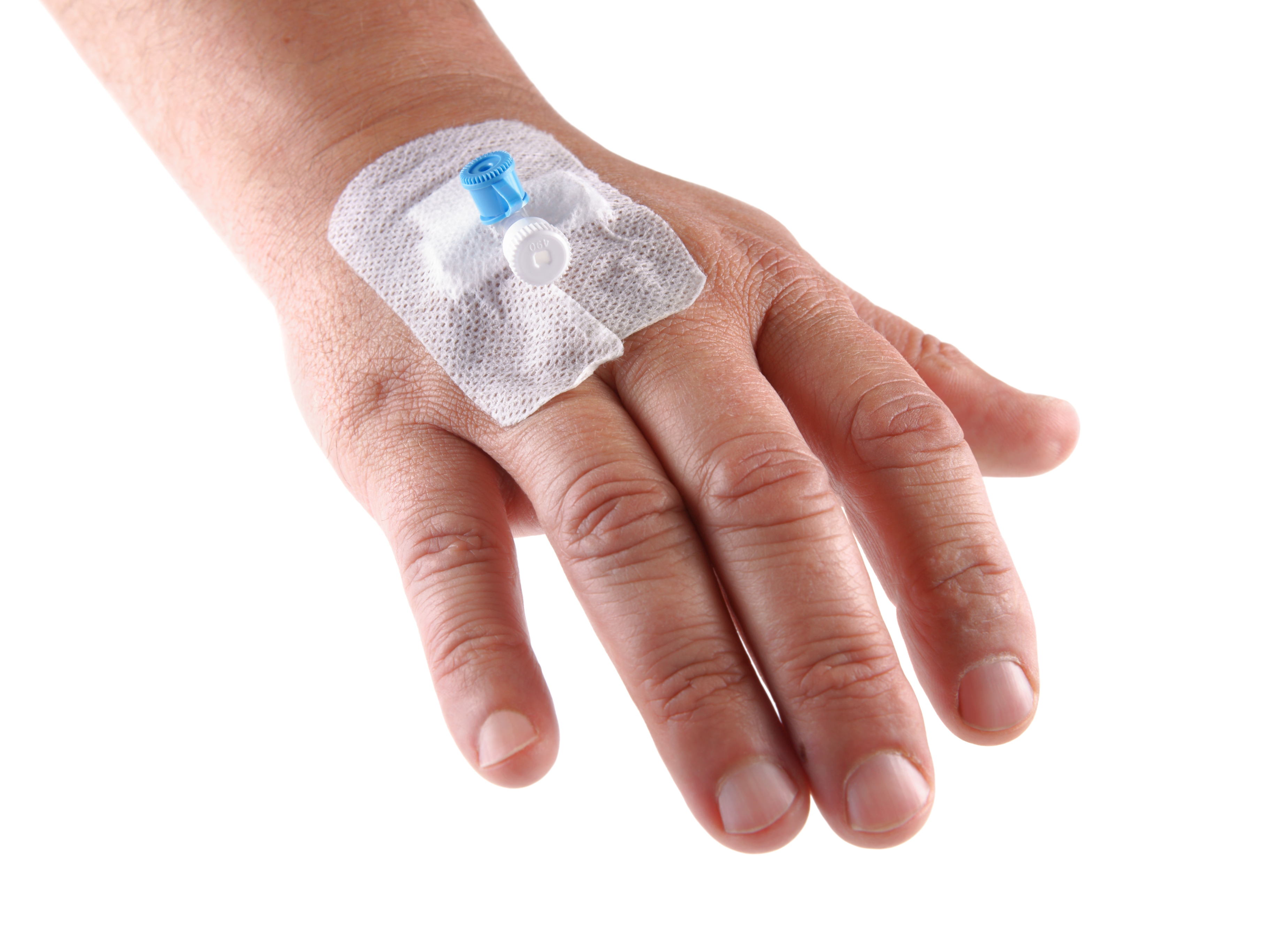 cannula in back of hand