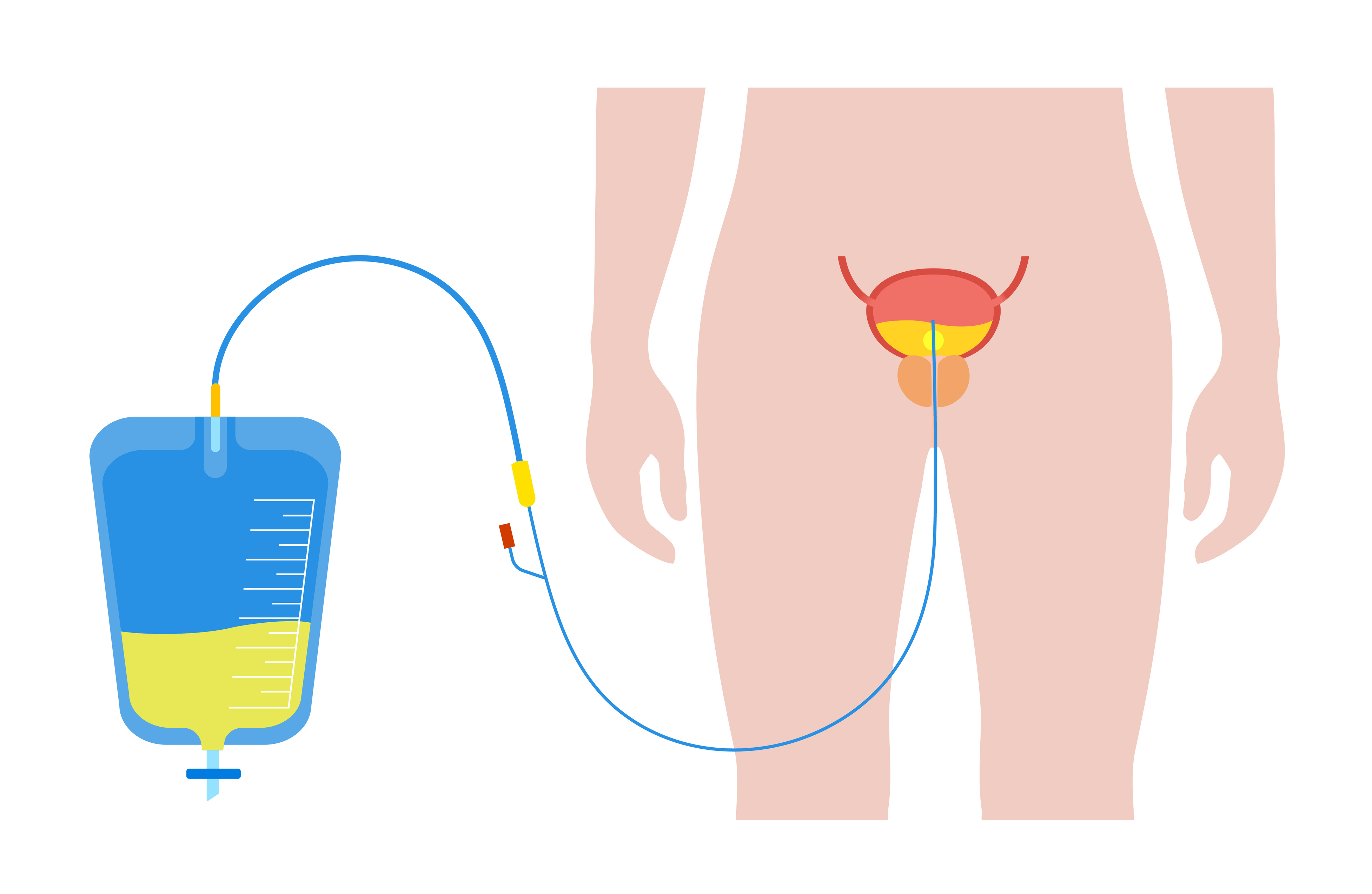 Image of a catheter in a bladder