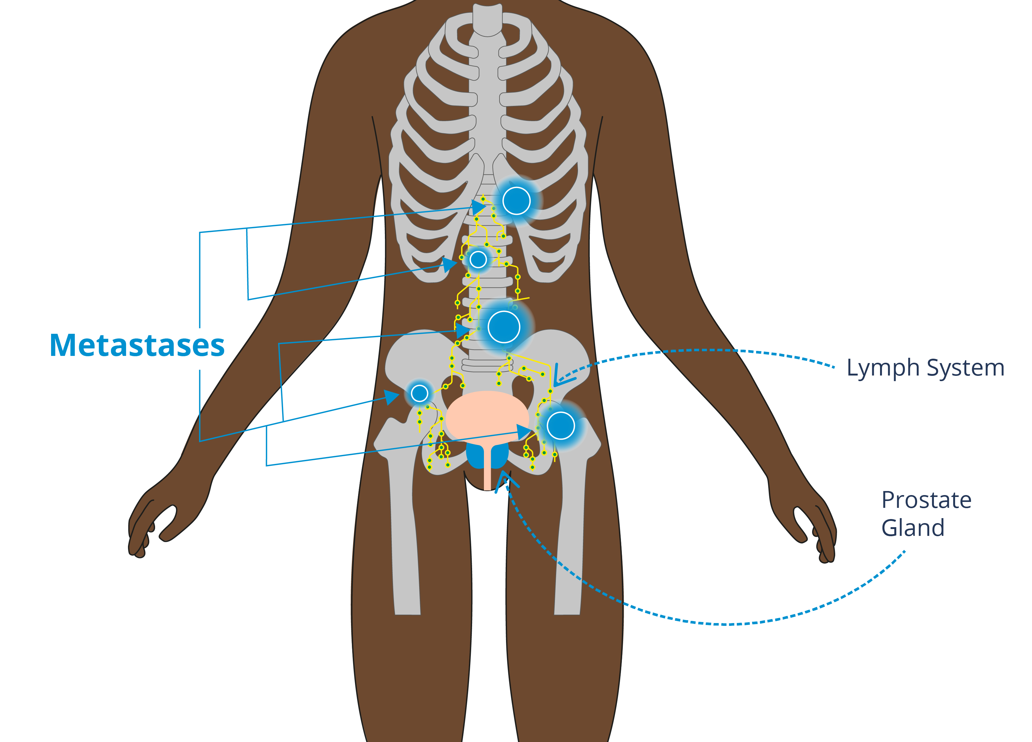 Image showing possible sites of prostate cancer metastases 