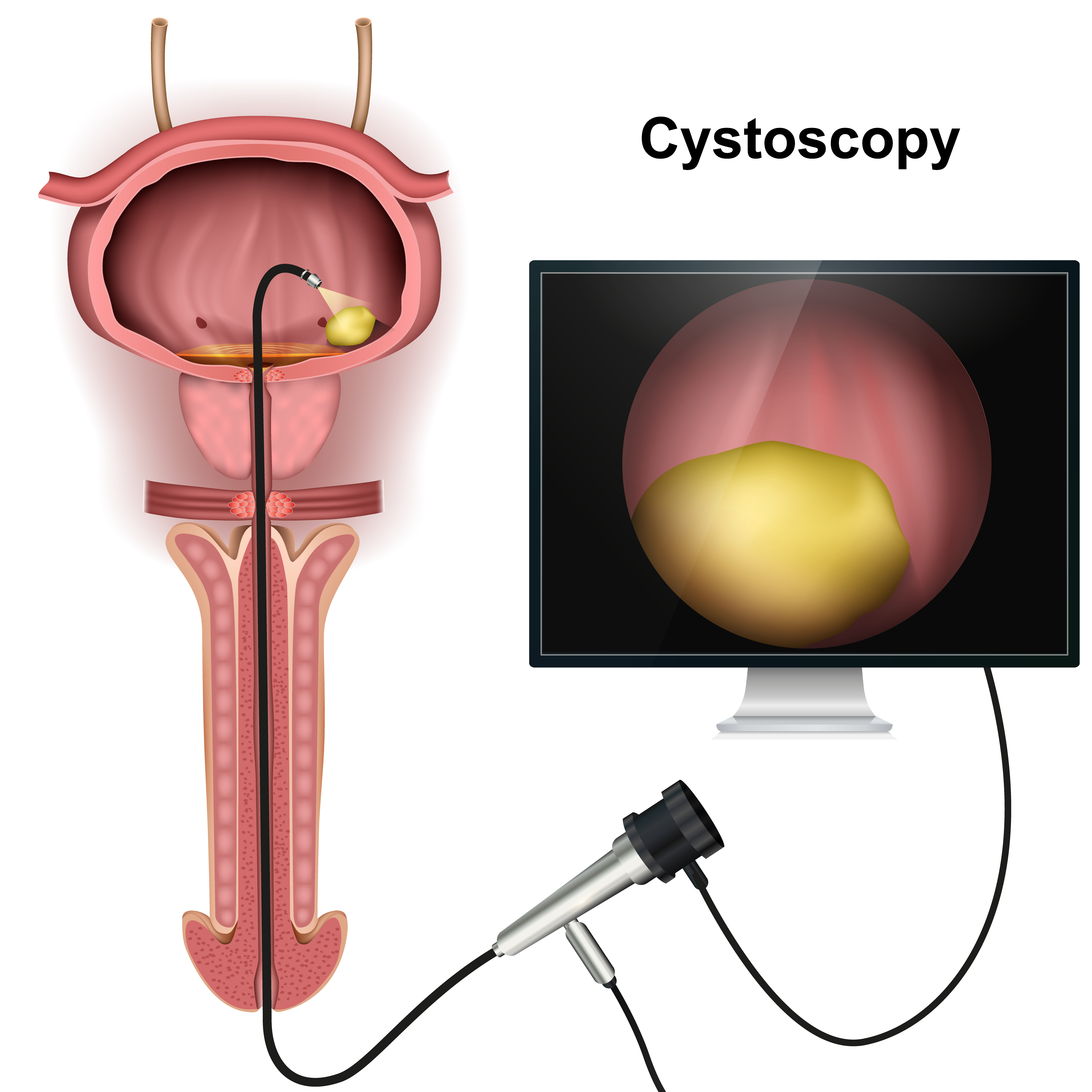 Male cystoscopy diagram