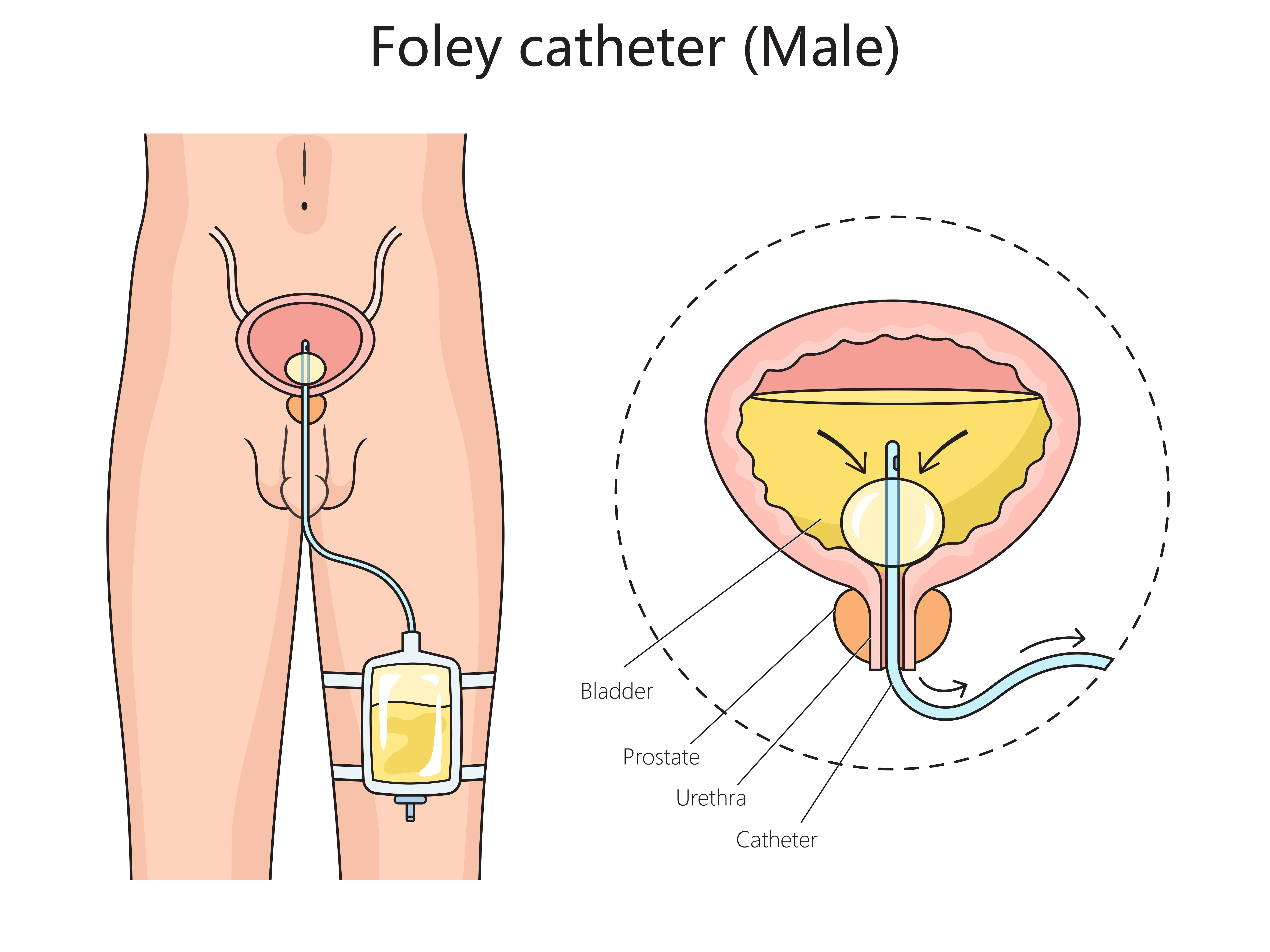 Image of urinary catheter on male 